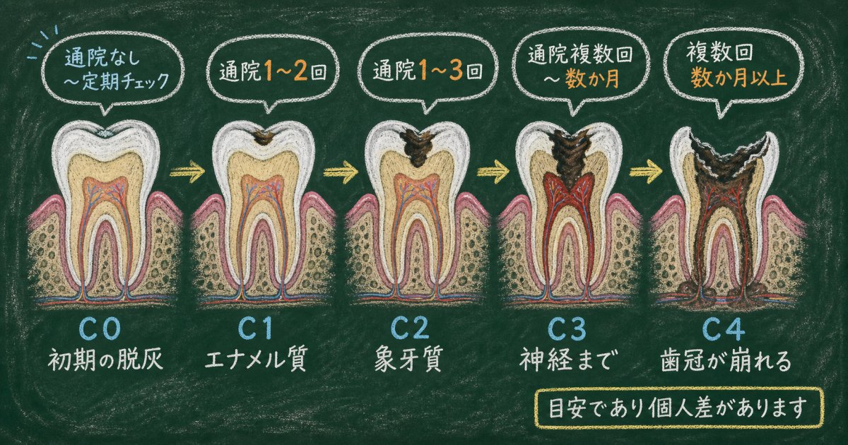 むし歯放置のリスクとは?痛みが消える理由と全身への健康被害