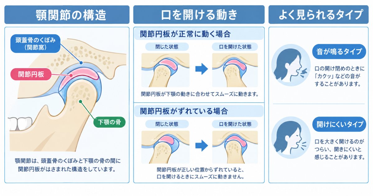顎がカクッと鳴る・開けにくくなる仕組みと歯並び・噛み合わせの関係