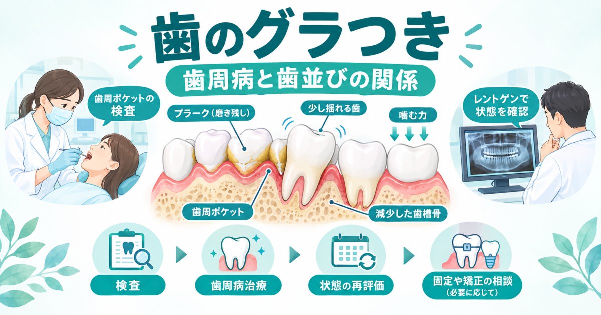 歯がグラつくのは歯周病と歯並びの関係から起こる仕組みと治療の判断基準