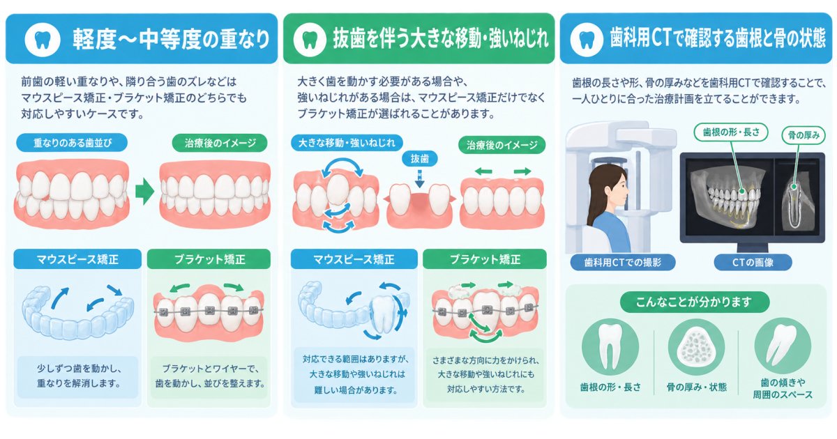 マウスピース矯正とブラケット矯正で対応を検討できる歯並びの違い